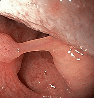 Папиллома небного язычка. Атлас эндоскопических изображений endoatlas